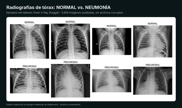 Clasificación de neumonía en radiografías de tórax — 1