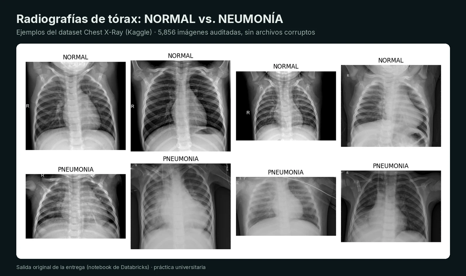 Clasificación de neumonía en radiografías de tórax — De una red densa a transfer learning con MobileNetV2 y datos sintéticos con GAN, con evaluación única en test